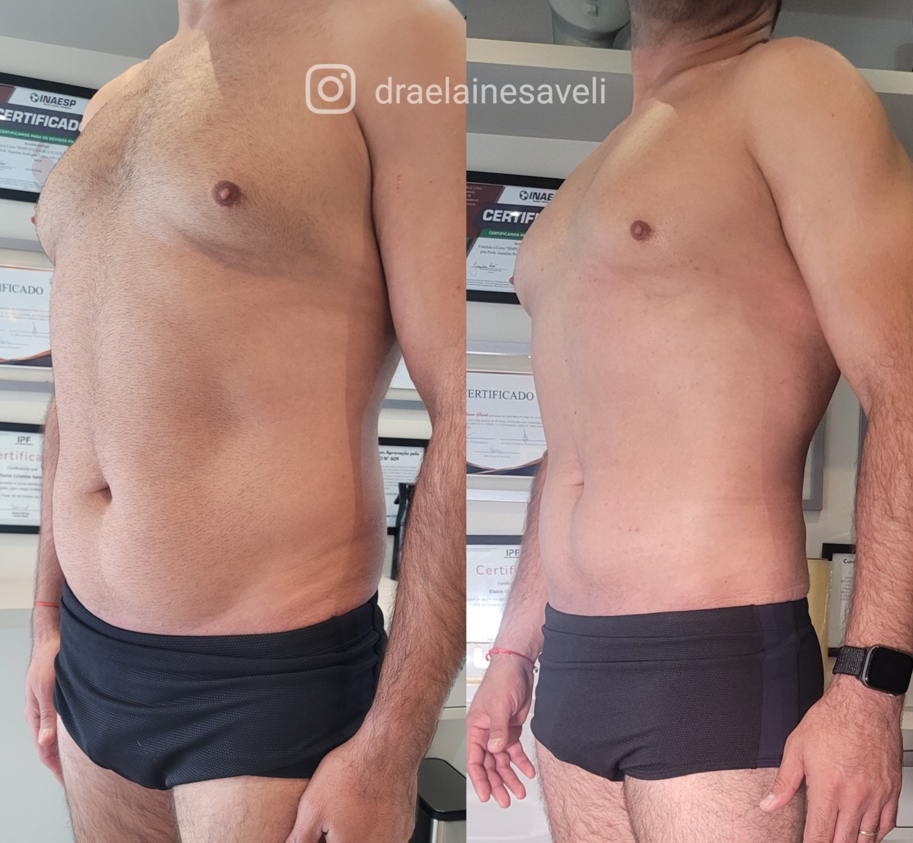 Antes e depois · Body Sculpt