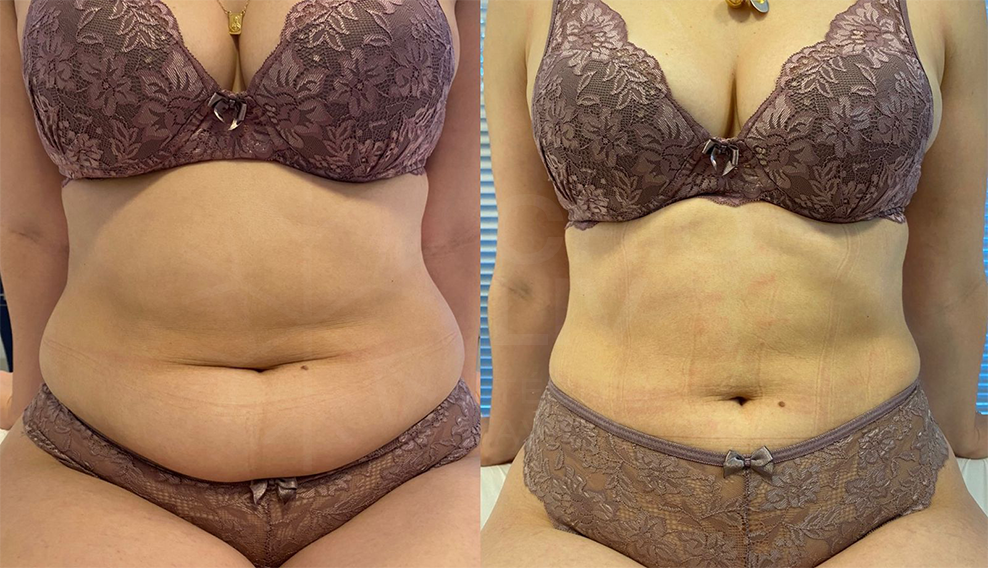 Antes e depois · Body Sculpt
